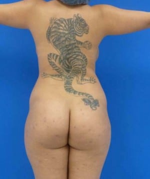 Brazilian Butt Lift before, case 1041, back view (Female, 26: BBL (1,000 cc per side))