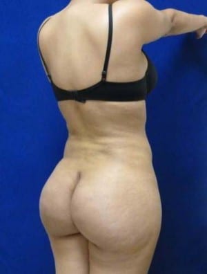 Brazilian Butt Lift after, case 1039, angle view (Female, 23: BBL (900 cc per side))