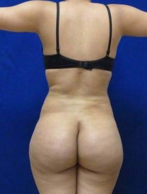 Brazilian Butt Lift after, case 1039, back view (Female, 23: BBL (900 cc per side))