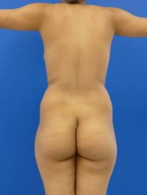 Brazilian Butt Lift before, case 1039, back view (Female, 23: BBL (900 cc per side))