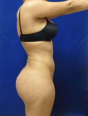 Brazilian Butt Lift after, case 1039, side view (Female, 23: BBL (900 cc per side))