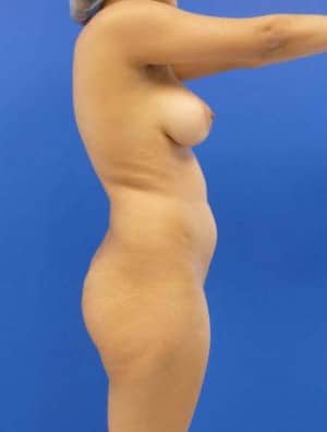 Brazilian Butt Lift before, case 1039, side view (Female, 23: BBL (900 cc per side))