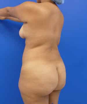 Brazilian Butt Lift before, case 1038, angle view (Female, 29: BBL (1,400 cc per side))