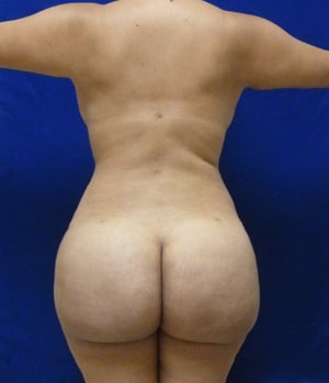 Brazilian Butt Lift after, case 1038, back view (Female, 29: BBL (1,400 cc per side))