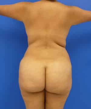 Brazilian Butt Lift before, case 1038, back view (Female, 29: BBL (1,400 cc per side))