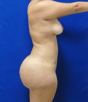 Brazilian Butt Lift after, case 1038, side view (Female, 29: BBL (1,400 cc per side))