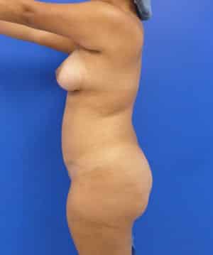 Brazilian Butt Lift before, case 1038, side view (Female, 29: BBL (1,400 cc per side))