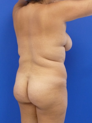 Brazilian Butt Lift before, case 1036, angle view (Female, 35: BBL (1,300 cc per side))