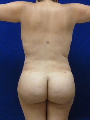 Brazilian Butt Lift after, case 1036, back view (Female, 35: BBL (1,300 cc per side))