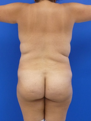 Brazilian Butt Lift before, case 1036, back view (Female, 35: BBL (1,300 cc per side))