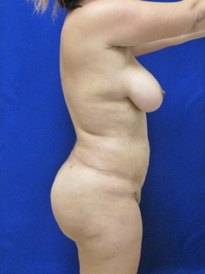 Brazilian Butt Lift after, case 1036, side view (Female, 35: BBL (1,300 cc per side))