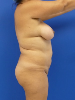 Brazilian Butt Lift before, case 1036, side view (Female, 35: BBL (1,300 cc per side))
