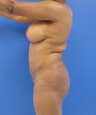 Brazilian Butt Lift before, case 1088, side view (Female, 47: BBL (750 cc per side) + J-Plasma®)