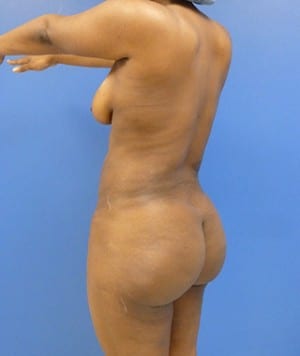 Brazilian Butt Lift after, case 1034, angle view (Female, 32: BBL (1,100 cc per side))