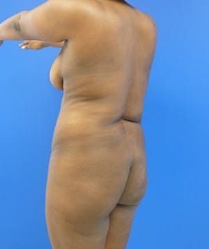 Brazilian Butt Lift before, case 1034, angle view (Female, 32: BBL (1,100 cc per side))