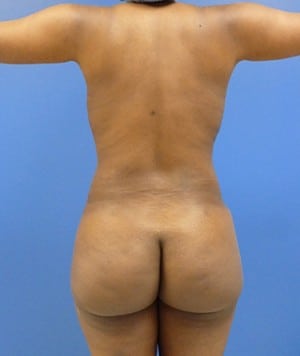 Brazilian Butt Lift after, case 1034, back view (Female, 32: BBL (1,100 cc per side))