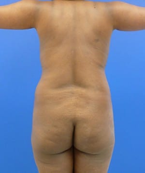 Brazilian Butt Lift before, case 1034, back view (Female, 32: BBL (1,100 cc per side))