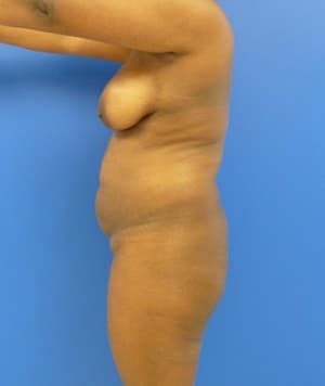 Brazilian Butt Lift before, case 1034, side view (Female, 32: BBL (1,100 cc per side))
