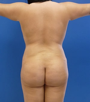 Brazilian Butt Lift before, case 1033, back view (Female, 27: BBL (1,200 cc per side))