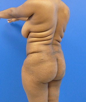 Brazilian Butt Lift before, case 1032, angle view (Female, 28: BBL (1,500 cc per side))