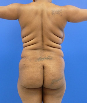 Brazilian Butt Lift before, case 1032, back view (Female, 28: BBL (1,500 cc per side))