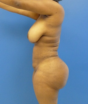 Brazilian Butt Lift after, case 1032, side view (Female, 28: BBL (1,500 cc per side))
