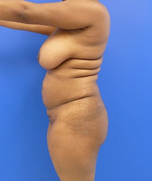 Brazilian Butt Lift before, case 1032, side view (Female, 28: BBL (1,500 cc per side))