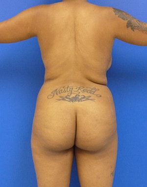 Brazilian Butt Lift before, case 1031, back view (Female, 28: BBL (1,300 cc per side))