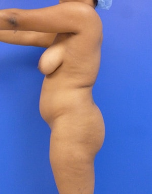 Brazilian Butt Lift before, case 1031, side view (Female, 28: BBL (1,300 cc per side))