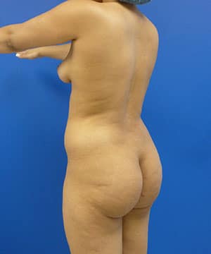 Brazilian Butt Lift before, case 1030, angle view (Female, 29: BBL (1,250 cc per side))