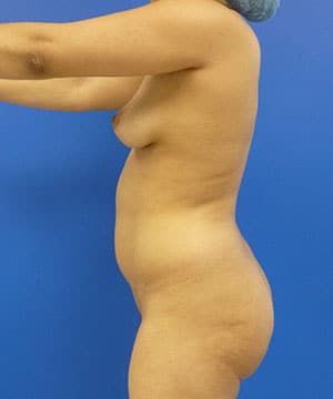 Brazilian Butt Lift before, case 1030, side view (Female, 29: BBL (1,250 cc per side))