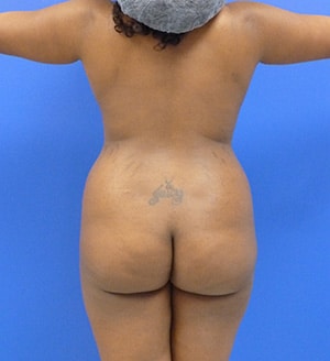 Brazilian Butt Lift before, case 1029, back view (Female, 28: BBL (1,300 cc per side))