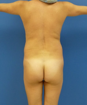 Brazilian Butt Lift before, case 1028, back view (Female, 32: BBL (950 cc per side))