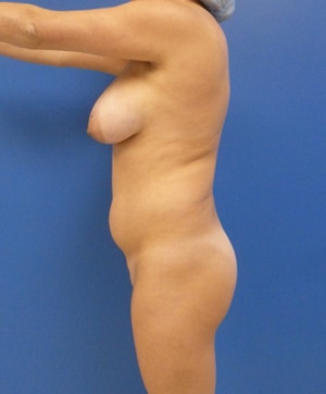 Brazilian Butt Lift before, case 1028, side view (Female, 32: BBL (950 cc per side))