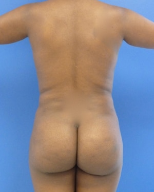 Brazilian Butt Lift after, case 1027, back view (Female, 25: BBL (550 cc per side))