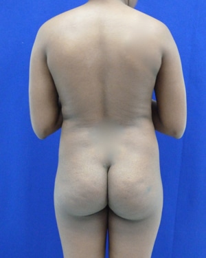 Brazilian Butt Lift before, case 1027, back view (Female, 25: BBL (550 cc per side))