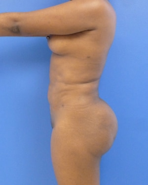 Brazilian Butt Lift after, case 1027, side view (Female, 25: BBL (550 cc per side))