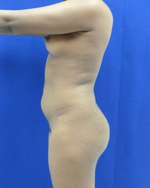 Brazilian Butt Lift before, case 1027, side view (Female, 25: BBL (550 cc per side))