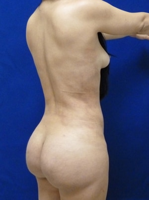 Brazilian Butt Lift after, case 1002, angle view (Female, 30: BBL (1,150 cc per side))