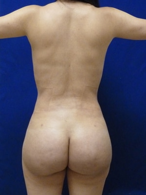 Brazilian Butt Lift after, case 1002, back view (Female, 30: BBL (1,150 cc per side))