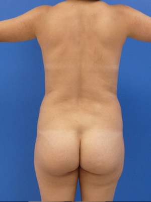 Brazilian Butt Lift before, case 1002, back view (Female, 30: BBL (1,150 cc per side))