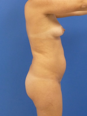 Brazilian Butt Lift before, case 1002, side view (Female, 30: BBL (1,150 cc per side))