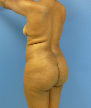 Brazilian Butt Lift before, case 1087, oblique view (Female, 51: BBL (900 cc per side))