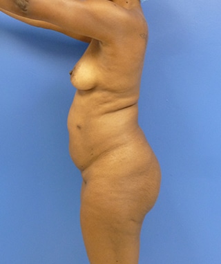 Brazilian Butt Lift before, case 1087, side view (Female, 51: BBL (900 cc per side))