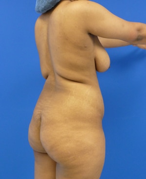 Brazilian Butt Lift before, case 1025, angle view (Female, 27: BBL (1,300 cc per side))