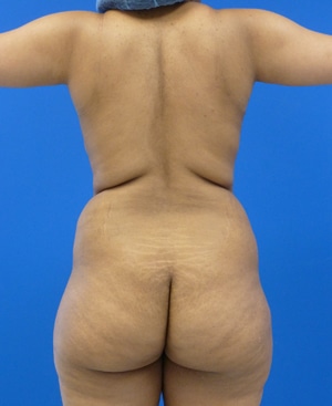 Brazilian Butt Lift before, case 1025, back view (Female, 27: BBL (1,300 cc per side))