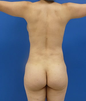 Brazilian Butt Lift after, case 1024, back view (Female, 44: BBL (1,200 cc per side))