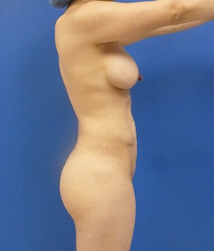 Brazilian Butt Lift after, case 1024, side view (Female, 44: BBL (1,200 cc per side))