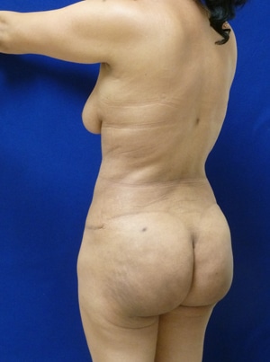 Brazilian Butt Lift after, case 1023, angle view (Female, 51: BBL (1,100 cc per side))
