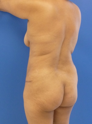 Brazilian Butt Lift before, case 1023, angle view (Female, 51: BBL (1,100 cc per side))